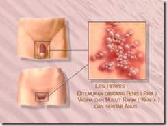 vaginal delivery herpes Brazilian porn photo